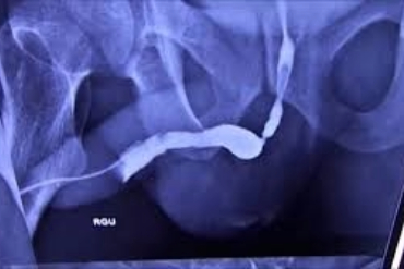 Urethral Stricture